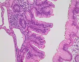 Fundic gland polyp with dysplasia (center), compared to normal mucosa (at right).