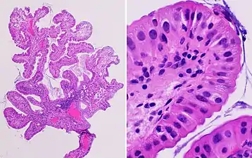 Histopathology of a hyperplastic polyp: There is no dysplasia.