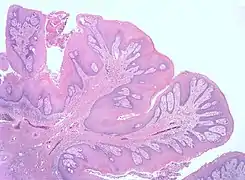 Histopathology of the same papilloma.