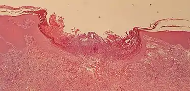Histopathology, showing an ulceration surrounded by acanthosis and parakeratosis, with absence of atypia.