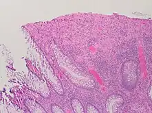Ulceration (seen here as absence of epithelium, and granulation tissue with many fibroblasts)