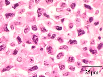 Extranodal NK/T cell lymphoma, nasal type for comparison. These lymphoma cells are typically monotonous, with folded nuclei, indistinct nucleoli and moderate amount of cytoplasm.