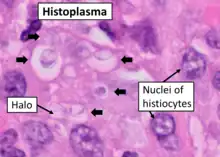 Histopathology of Histoplasma capsulatum, H&E stain, showing organisms surrounded by halos, in a granuloma of epithelioid histiocytes.