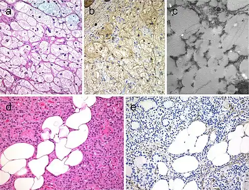 Lipid-rich follicular thyroid carcinoma (a) immunoreactive for thyroglobulin (b); the ultrastructural study evidenced numerous lipid vacuoles in the cytoplasm (ultrastructure) (c). Adenolipoma (lipoadenoma) in a patient with PTEN hamartoma tumor syndrome (d); there is negativity for PTEN protein in tumor cells while stromal cells (internal positive control) are positive (e)