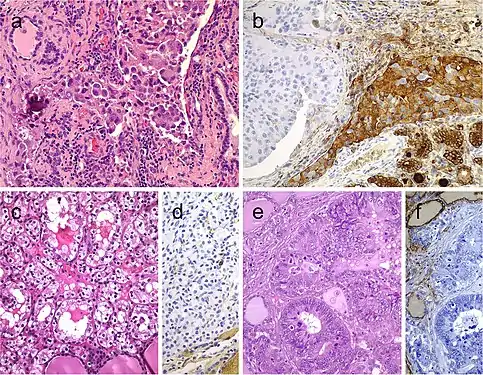 Metastatic carcinomas in the thyroid gland. Thyroid metastasis from lung adenocarcinoma (a, b). Some metastatic tumor cells (right) are positive for thyroglobulin due to diffusion artifact and should not be overinterpreted as positive (b). Metastatic clear cell renal carcinoma (c), metastatic renal cells are negative for thyroglobulin (d). Colonic adenocarcinoma metastatic to the thyroid gland (e); the thyroid tissue is positive for thyroglobulin while the metastatic adenocarcinoma is negative (f)