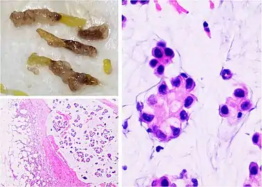 Mucinous carcinoma of the breast: Gross pathology (upper left) of mucinous carcinoma shows gelatinous areas. Histopathology shows clusters or nests of tumor cells floating in pools of extracellular mucin.