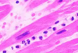 Neutrophils are seen in a myocardial infarction at approximately 12–24 hours, as seen in this micrograph.