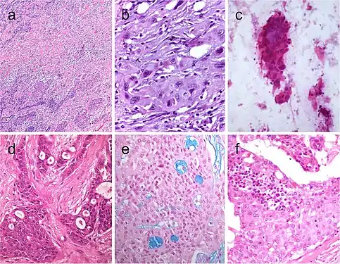 Squamous cell tumor examples that include extensive squamous metaplasia in PTC after fine needle aspiration biopsy (FNAB) (a), squamous cell carcinoma in the thyroid of putative secondary origin (b), and squamous cell carcinoma of the esophagus metastatic in the thyroid and diagnosed by FNAB (c). Mucoepidermoid carcinoma (d) composed by solid sheets of epithelial cells showing epidermoid cells and glandular spaces containing mucinous material positively stained with Alcian blue (e). Sclerosing mucoepidermoid carcinoma with eosinophilia showing epithelial cells richly infiltrated by eosinophils, lymphocytes, and plasma cells (f)