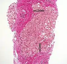 Histopathology of steatohepatitis with established cirrhosis, with thick bands of fibrosis (Van Gieson's stain)