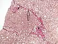 Histopathology of steatohepatitis with moderate fibrosis, with thin fibrous bridges (Van Gieson's stain)