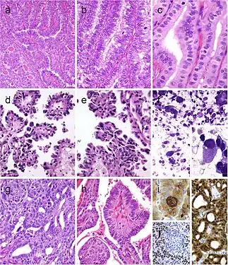Columnar cell variant of papillary thyroid carcinoma (PTC) showing a combination of papillary and glandular-like patterns (a), marked nuclear pseudostratification, and less nuclear features of classic PTC (b). In the tall cell variant of PTC, the cytoplasm is deeply eosinophilic, and nuclear features of PTC are very prominent with irregular contours and common pseudoinclusions (c). Hobnail variant of PTC combining papillary (d), and micropapillary (e) structures lined by hobnail cells. “Teardrop” cells (f) and comet-like cells (inset). The cribriform-morular thyroid carcinoma exhibits a blending of cribriform, papillary, trabecular, and solid pattern with morules (g) and (h). Morules are strongly positive for CD10 (i). Tumor cells are reactive for estrogen receptors (j), and there is strong nuclear and cytoplasmic reactivity for β-catenin (k)
