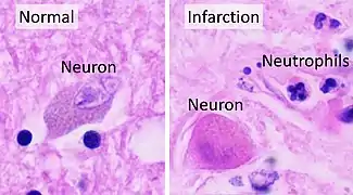 In stroke, they are beginning to infiltrate the infarcted brain after 6 to 8 hours.