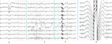 Common artifacts in human EEG. 1: Electrooculographic artifact caused by the excitation of eyeball's muscles (related to blinking, for example). Big-amplitude, slow, positive wave prominent in frontal electrodes. 2: Electrode's artifact caused by bad contact (and thus bigger impedance) between P3 electrode and skin. 3: Swallowing artifact. 4: Common reference electrode's artifact caused by bad contact between reference electrode and skin. Huge wave similar in all channels.