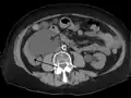 Massive hydronephrosis as marked by the arrow.