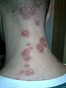 Impetigo on the back of the neck.