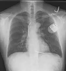 A chest film after insertion of an implantable cardioverter-defibrillator, showing the shock generator in the upper left chest and the electrical lead inside the right heart. Note both radio-opaque coils along the device lead.