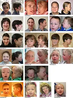 An image displaying 18 individuals who have Snijders Blok-Campeau syndrome
