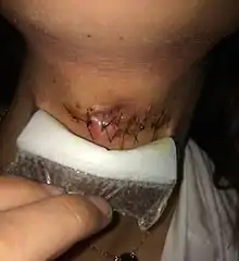 Post surgery infection on a Thyroglossal Cyst, reaction from stitches.
