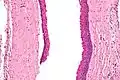 High magnification of an odontogenic keratocyst.