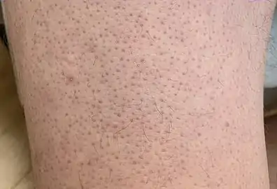 Keratosis pilaris on lower extremity