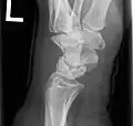 Left hand x-ray with Kienbock's Disease
