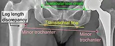 Leg length discrepancy after hip replacement is calculated as the vertical distance between the middle of the minor trochanters, using the acetabular tear drops or the transischial line as references for the horizontal plane. A discrepancy of up to 1 cm is generally tolerated.