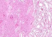 Low magnification micrograph of a Leydig cell tumour. H&E stain.
