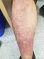 Lichen amyloidosis on a 56-year-old male's leg