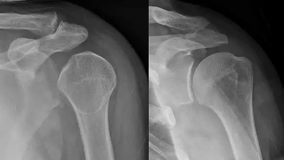 Shoulder dislocation before (left) and after (right) being reduced