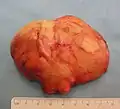 The resected lipoma(8 cm × 6 cm × 3 cm)