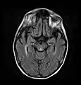 Axial MRI FLAIR image showing hyperintense signal in the periaqueductal gray matter and tectum of the dorsal midbrain