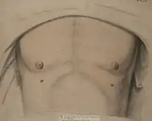 Drawing of a man with supernumerary nipples
