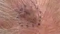 Melanoma in situ, vertex scalp marked for biopsy