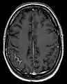 Meningeal carcinomatosis in a patient with breast cancer (contrast-enhanced axial T1-weighted MRI)
