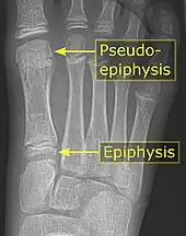 It is common in children to have a pseudo-epiphysis of the first metatarsal.
