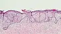 Fibroepitheliomatous pattern (anastomosing basaloid epithelial strands enclosing round islands of fibrous stroma)