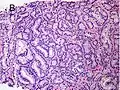 Gleason score 7 (3+4) with minor component of cribriform glands