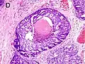 Gleason score 9 (4+5) with cribriform glands, some with necrosis