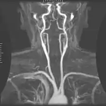 Magnetic Resonance Angiography; view from the front