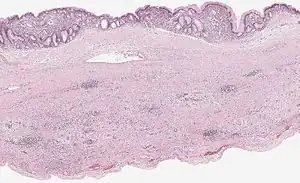 Mucinous cystadenoma of the pancreas