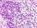 Histopathologic image of mucoepidermoid carcinoma of the major salivary gland. H & E stain
