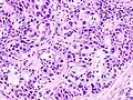 Histopathologic image of mucoepidermoid carcinoma of the major salivary gland. The same lesion as shown in a filename "Mucoepidermoid carcinoma (2) HE stain.jpg". H & E stain
