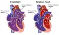Neonatal heart circulation