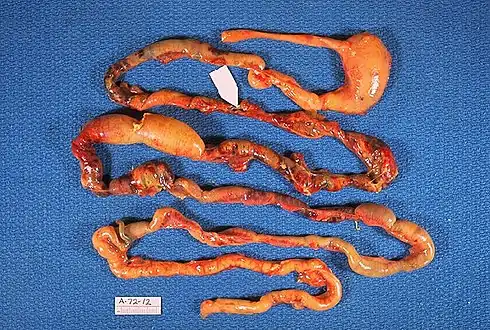 Alimentary tract of infant showing intestinal necrosis, pneumatosis intestinalis, and perforation site (arrow) (autopsy)