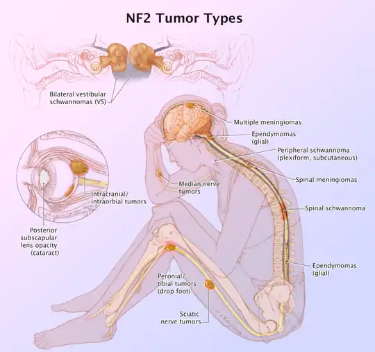 Figure of various morbidities associated with neurofibromatosis type II.