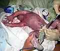 A newborn at 45 seconds, with umbilical cord clamped.