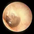 This is a normal left eardrum.