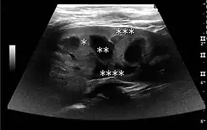 Figure 2. Normal pediatric kidney. * Column of Bertin; ** pyramid; *** cortex; **** sinus.