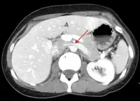 Compression of the left renal vein (marked by the arrow) between the superior mesenteric artery (above) and the aorta (below) due to nutcracker syndrome