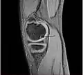 Sagittal MRI: High T2 signal at the articular surfaces of the lateral aspect of the medial femoral condyle confirms the presence of OCD. Diffuse increase in T2 signal at the medial femoral condyle indicates marrow edema.